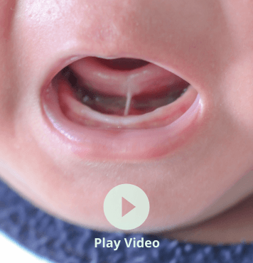 Frenectomy Video